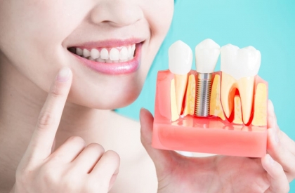 10 lý do nên cấy ghép Implant